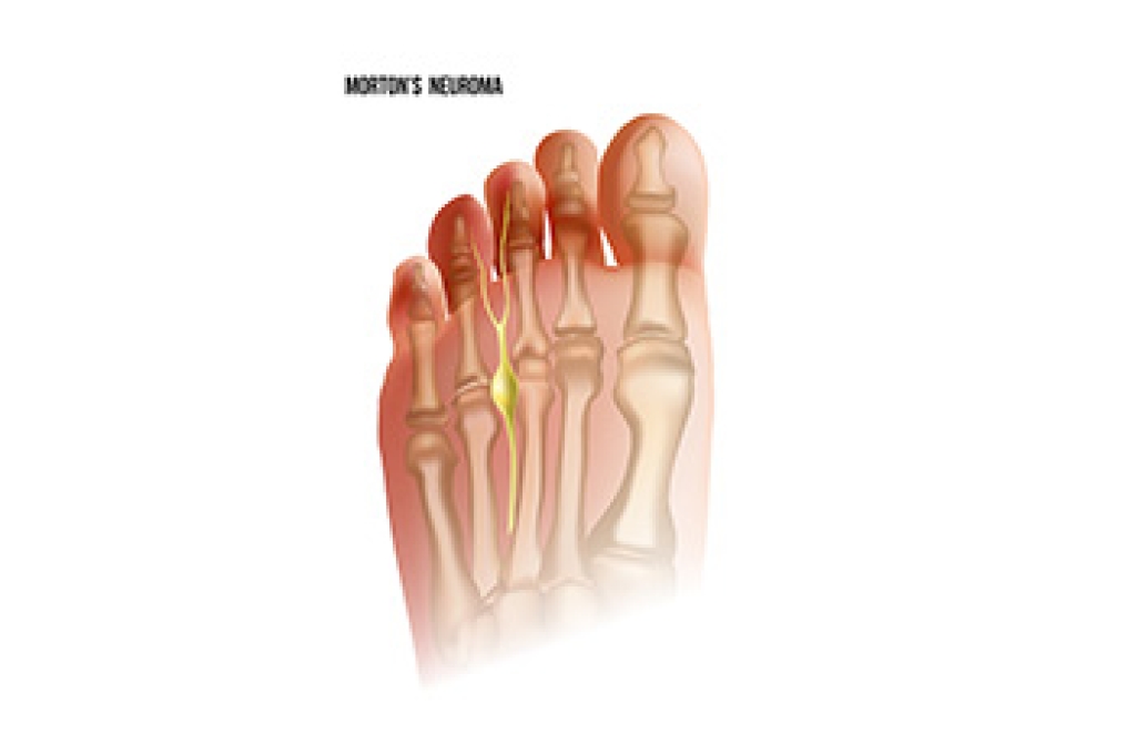 Nerve Pain From Morton’s Neuroma