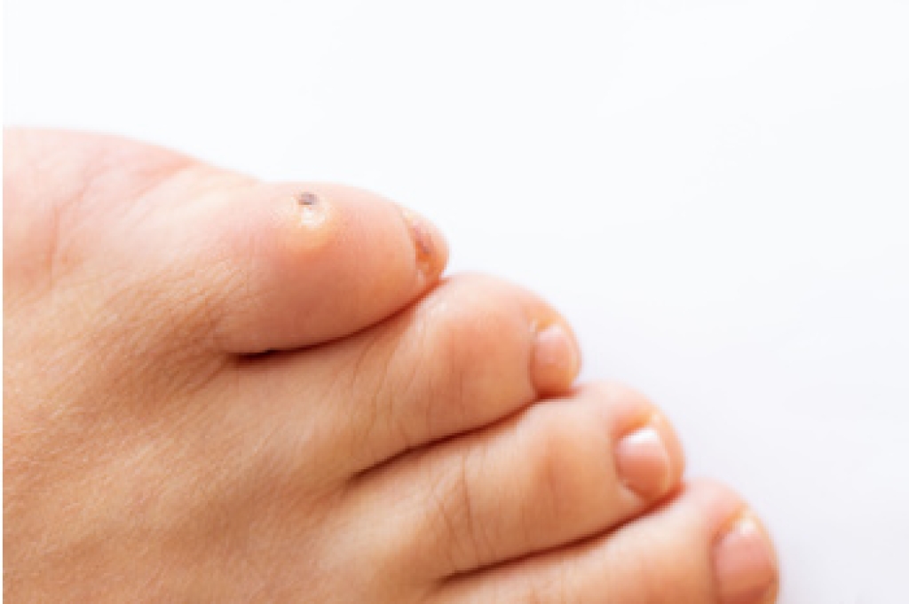 When Thickened Skin Becomes Painful