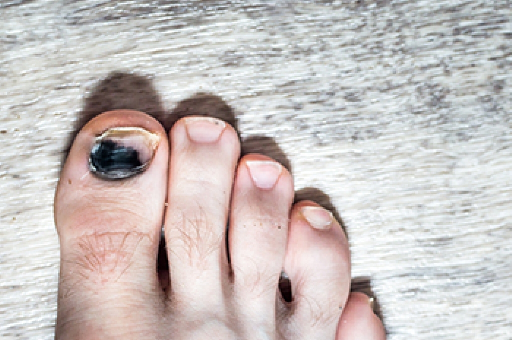 When a Black Toenail Needs a Podiatrist’s Attention