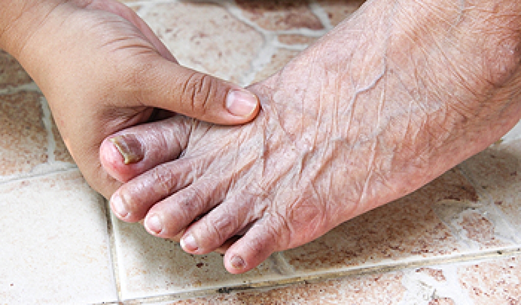 How to Recognize Toenail Fungus Early