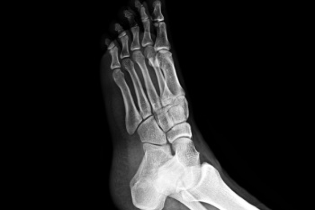 Understanding MTP Joint Pain