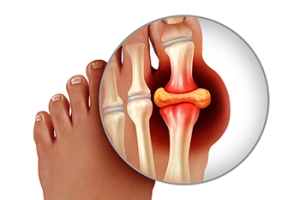 Gout Is Arthritis